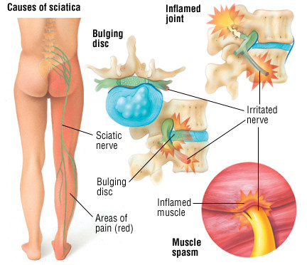 sciatica causes