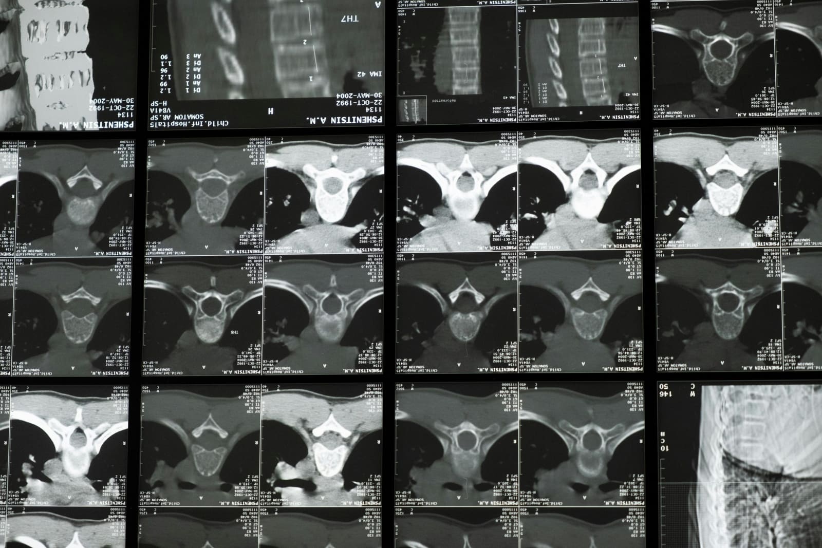 Radiological image of the human spine including the cervical vertebrae
