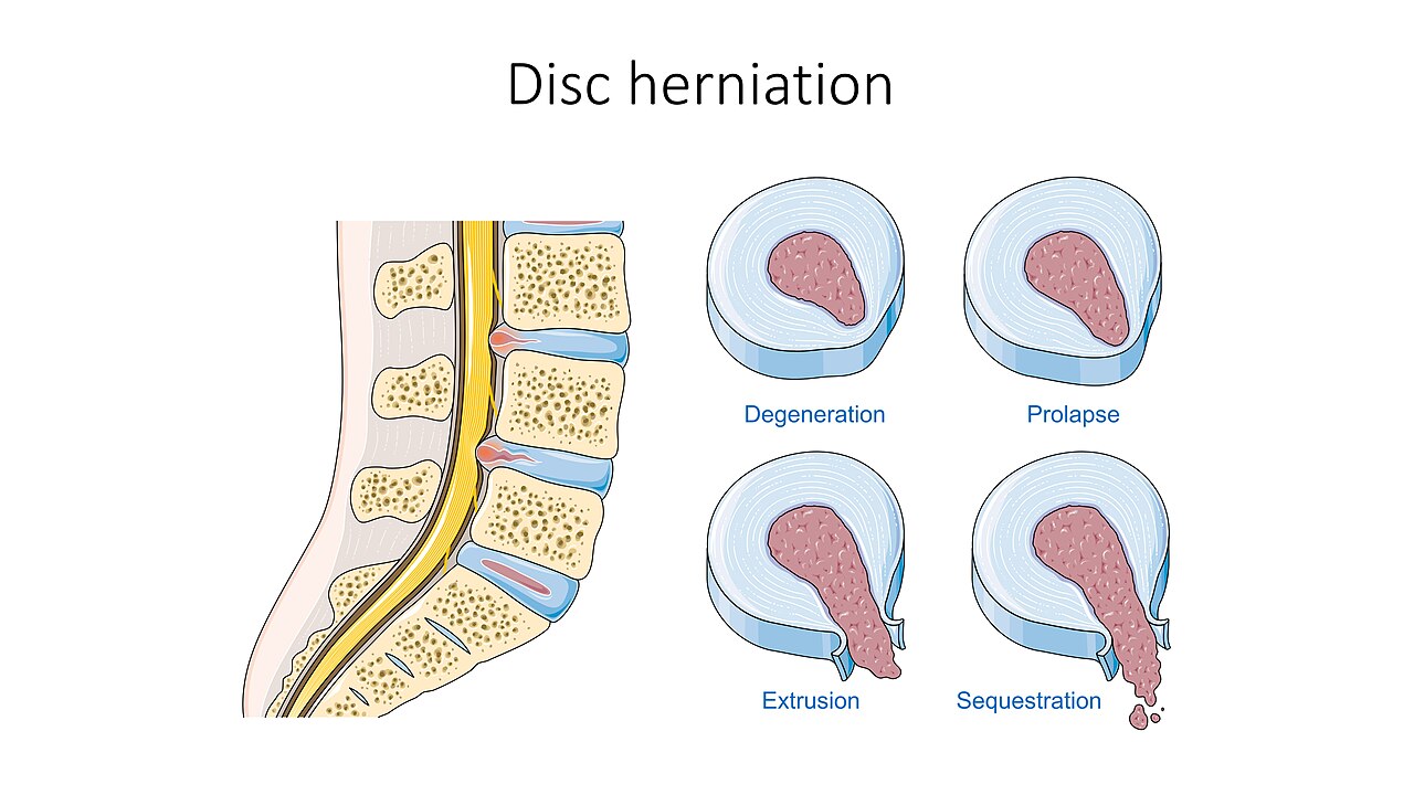 Medical illustration showing stages of intervertebral disc change from degeneration to herniation