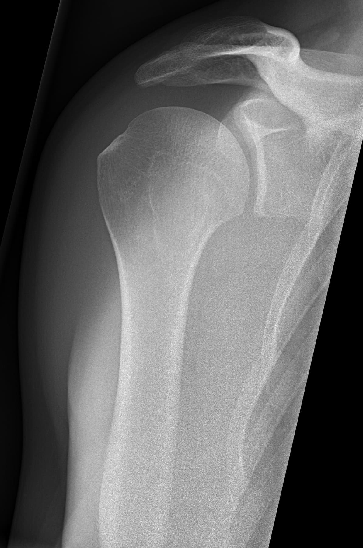 X-ray of a healthy shoulder joint