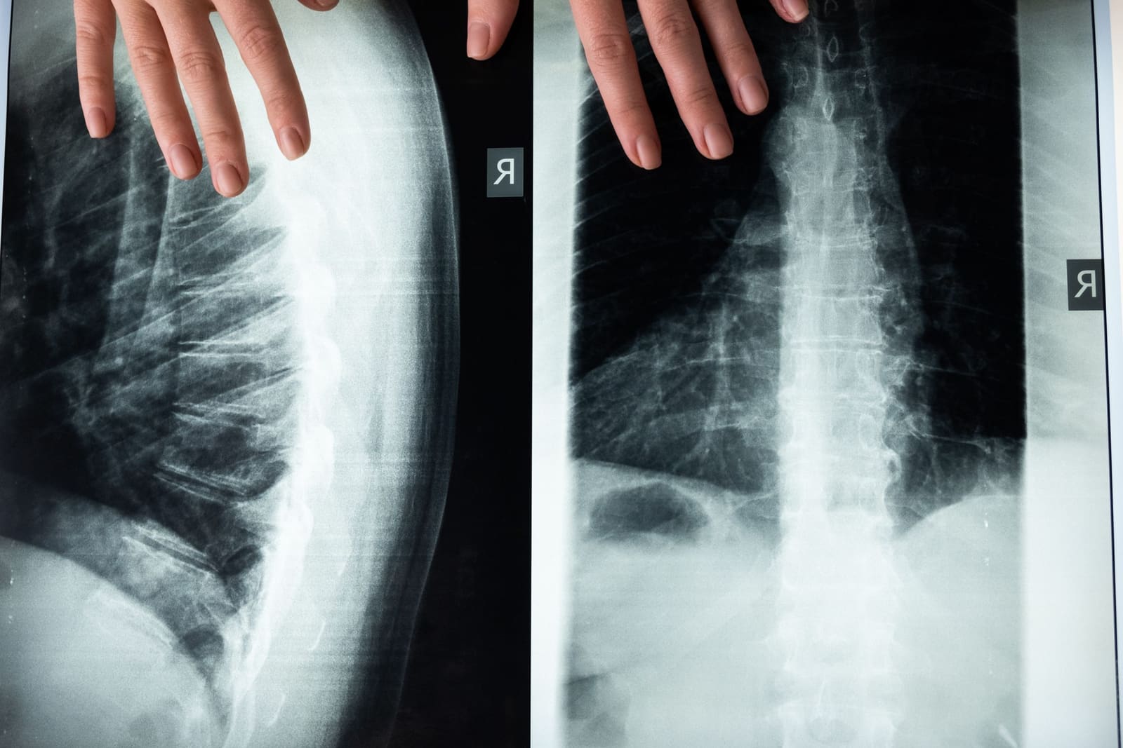 Medical X-ray image of the human spine