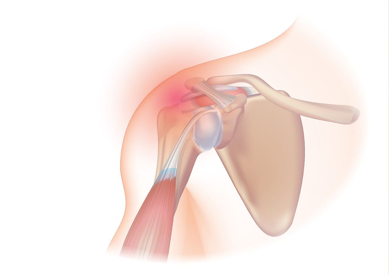 Illustration of the rotator cuff muscles and tendons around the shoulder joint