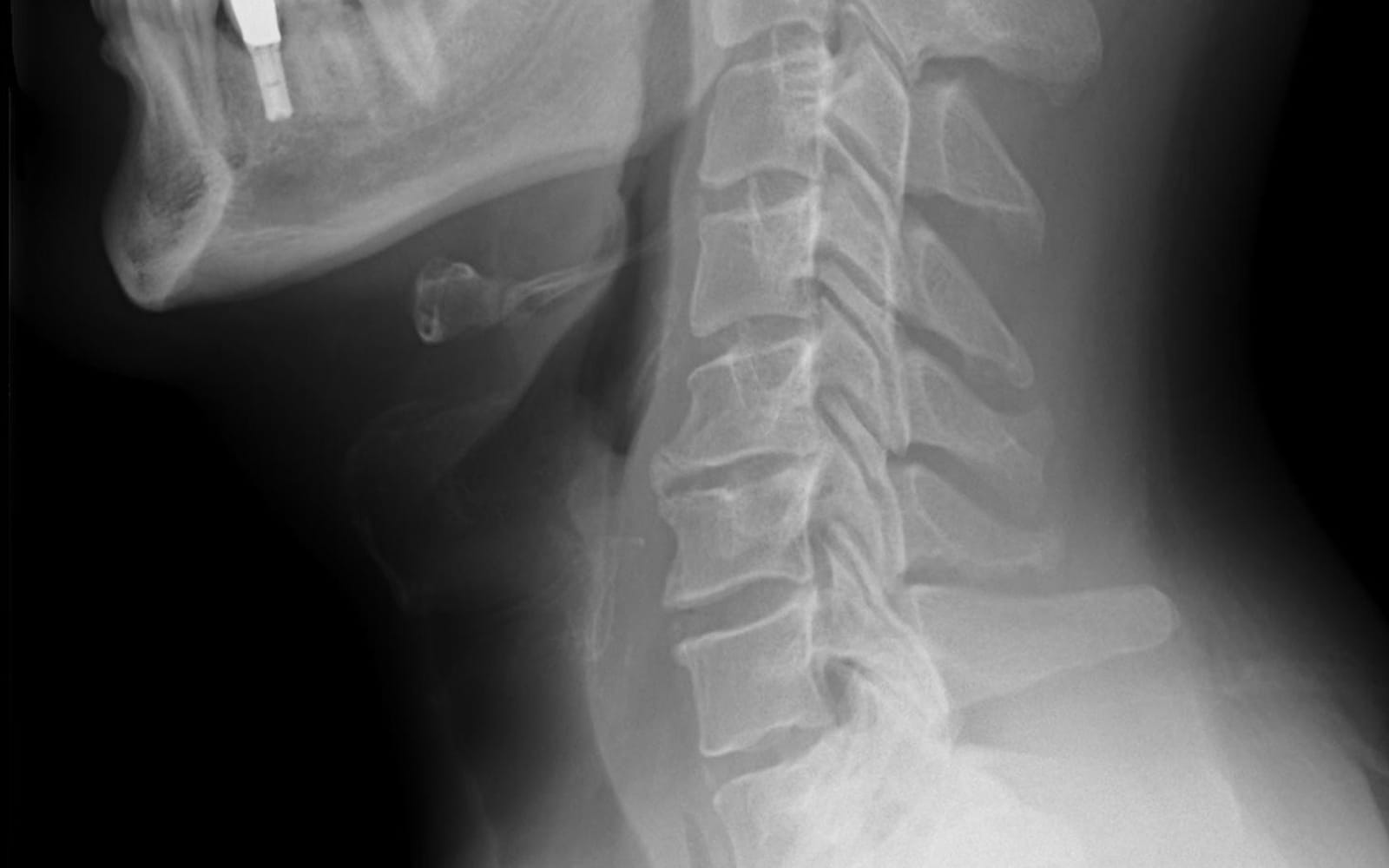 Lateral X-ray of the cervical spine showing the neck vertebrae