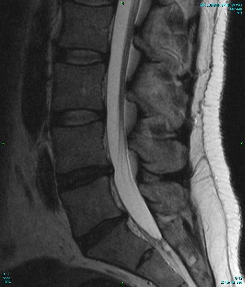 Sagittal MRI scan of the lumbar spine showing the stacked vertebrae and the discs between them