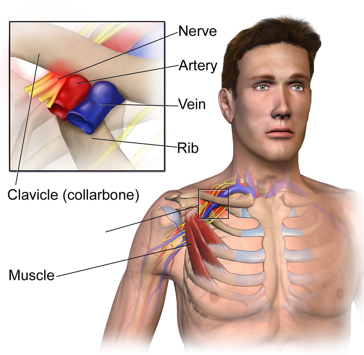 Illustration of the thoracic outlet showing a nerve, artery and vein squeezed between the collarbone and first rib